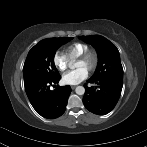 Chronic pulmonary embolus (Radiopaedia 39129-41341 Axial C+ CTPA 62).png