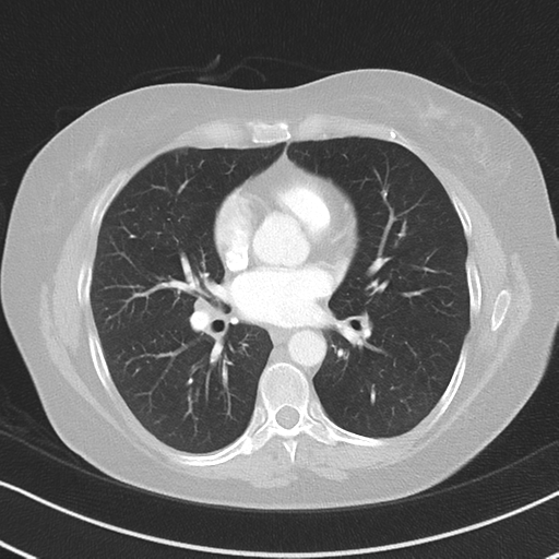 Chronic pulmonary embolus (Radiopaedia 39129-41341 Axial lung window 35).png