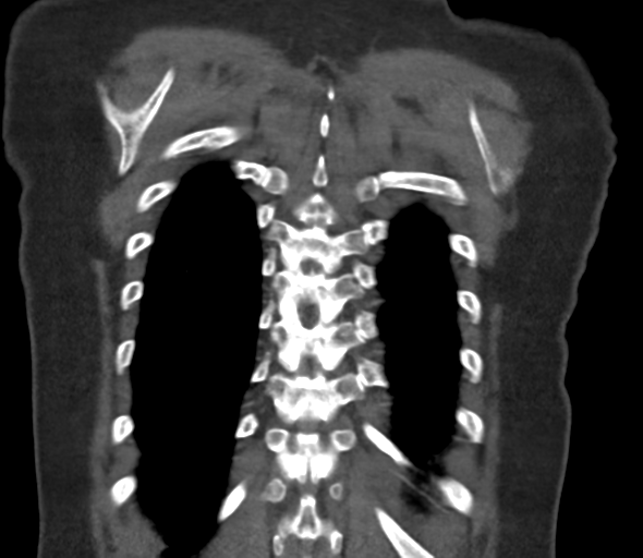 Chronic pulmonary embolus (Radiopaedia 39129-41341 Coronal C+ CTPA 73).png