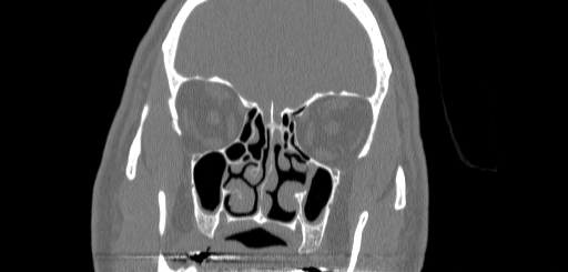 File:Chronic sphenoidal sinusitis (Radiopaedia 62030-70122 Coronal bone window 64).jpg