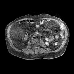 Cirrhosis and hepatocellular carcinoma in the setting of hemochromatosis (Radiopaedia 75394-86594 Axial T1 C+ fat sat 2).jpg