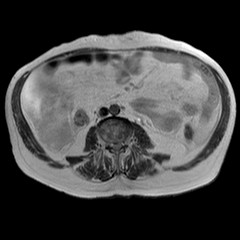 File:Cirrhosis and hepatocellular carcinoma in the setting of hemochromatosis (Radiopaedia 75394-86594 Axial T2 1).jpg