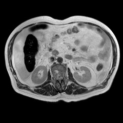 File:Cirrhosis and hepatocellular carcinoma in the setting of hemochromatosis (Radiopaedia 75394-86594 Axial T2 7).jpg