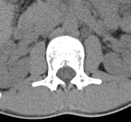 Clear cell meningoma - lumbar spine (Radiopaedia 60116-67691 Axial non-contrast 15).png
