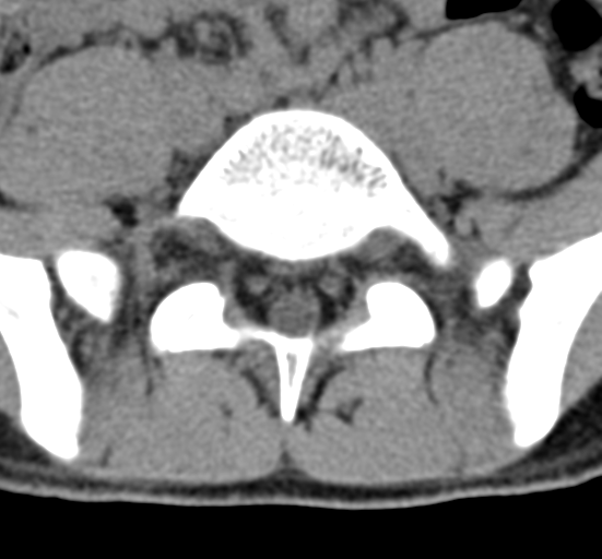 Clear cell meningoma - lumbar spine (Radiopaedia 60116-67691 Axial non-contrast 63).png