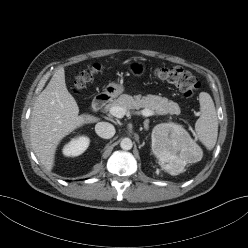 File:Clear cell renal cell carcinoma (Radiopaedia 61449-69393 E 19).jpg