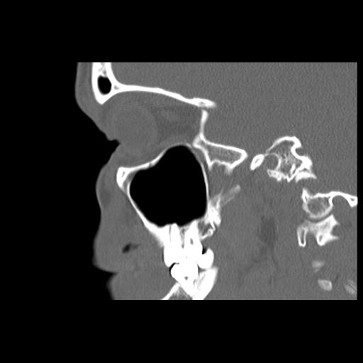 File:Cleft hard palate and alveolus (Radiopaedia 63180-71710 Sagittal bone window 34).jpg