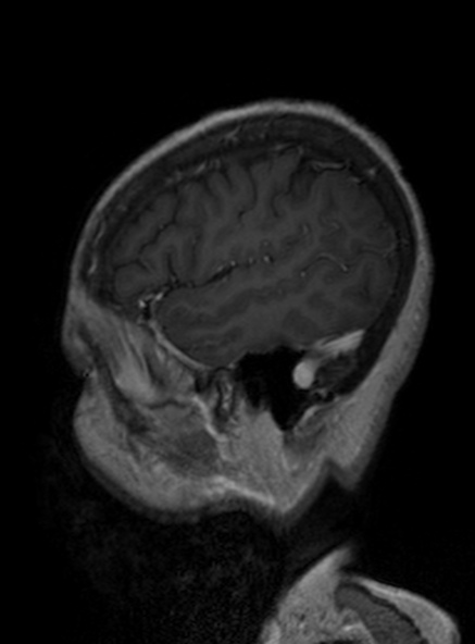 Clival meningioma (Radiopaedia 53278-59248 Sagittal T1 C+ 351).jpg