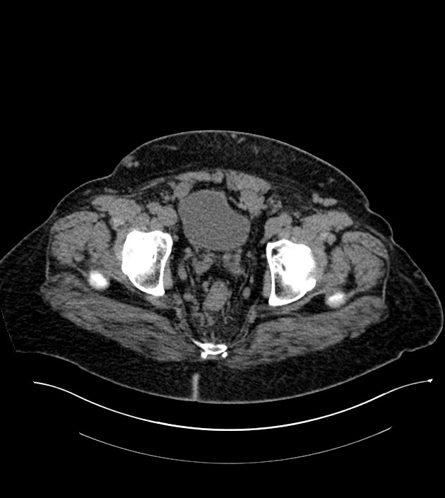 Closed-loop small bowel obstruction-internal hernia (Radiopaedia 78439-91096 Axial non-contrast 142).jpg