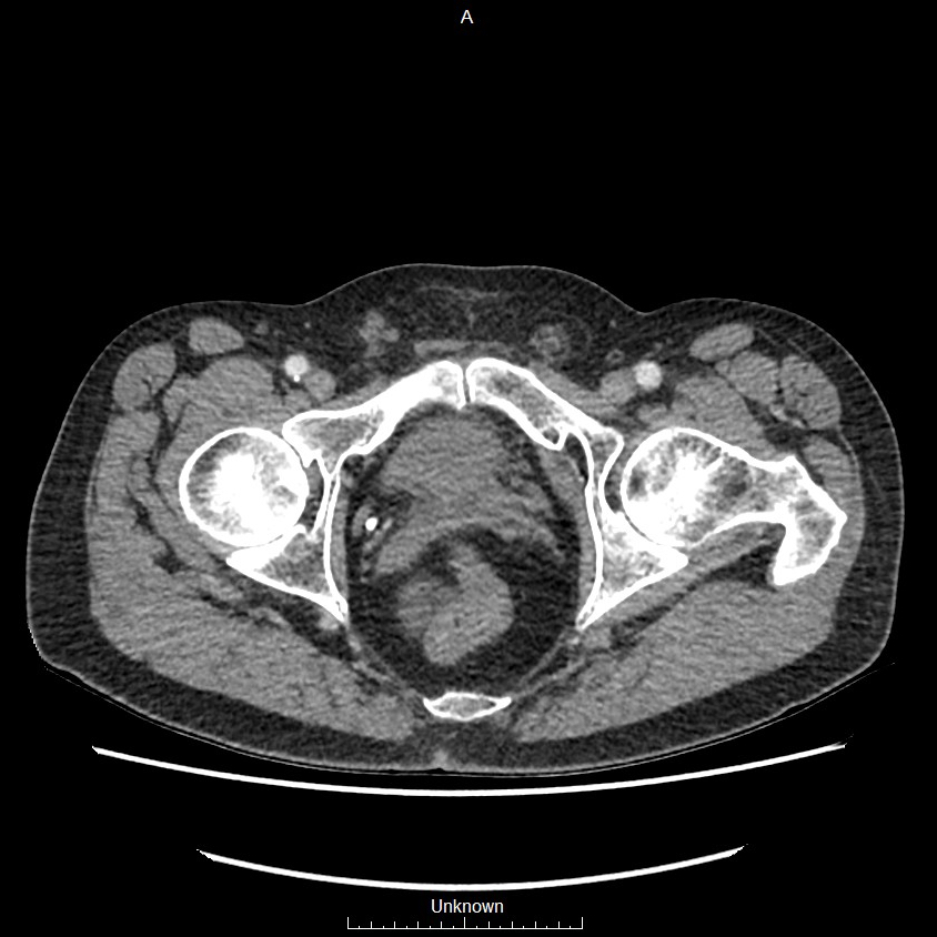 Closed loop bowel obstruction and ischemia (Radiopaedia 86959-103180 A 86).jpg