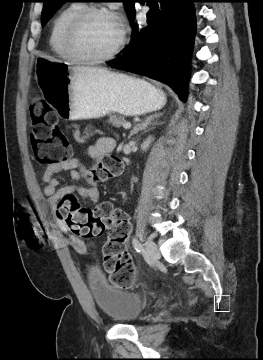 Closed loop obstruction - internal hernia into nephrectomy bed (Radiopaedia 59867-67320 C 34).jpg