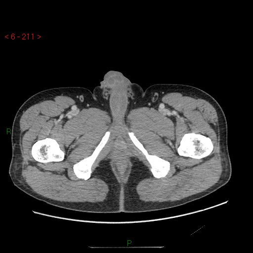 File:Closed loop obstruction and appendicular stump mucocele (Radiopaedia 54014-60163 A 129).jpg