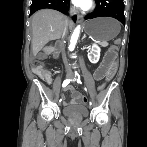 Closed loop obstruction due to adhesive band, resulting in small bowel ischemia and resection (Radiopaedia 83835-99023 C 67).jpg