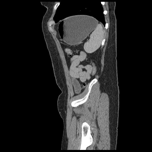 File:Closed loop small bowel obstruction (Radiopaedia 65403-74451 C 93).jpg