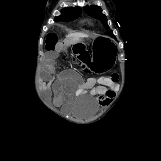 File:Closed loop small bowel obstruction - adhesive disease and hemorrhagic ischemia (Radiopaedia 86831-102990 B 30).jpg