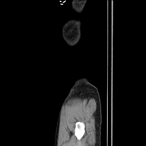 Closed loop small bowel obstruction - omental adhesion causing "internal hernia" (Radiopaedia 85129-100682 C 174).jpg