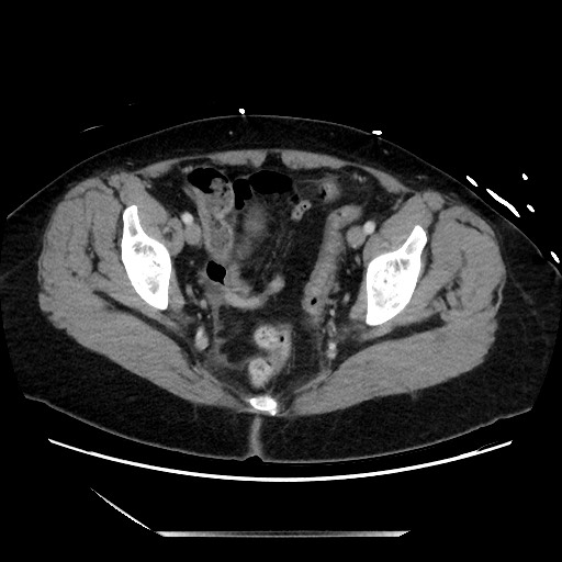 File:Closed loop small bowel obstruction due to adhesive bands - early and late images (Radiopaedia 83830-99014 A 135).jpg