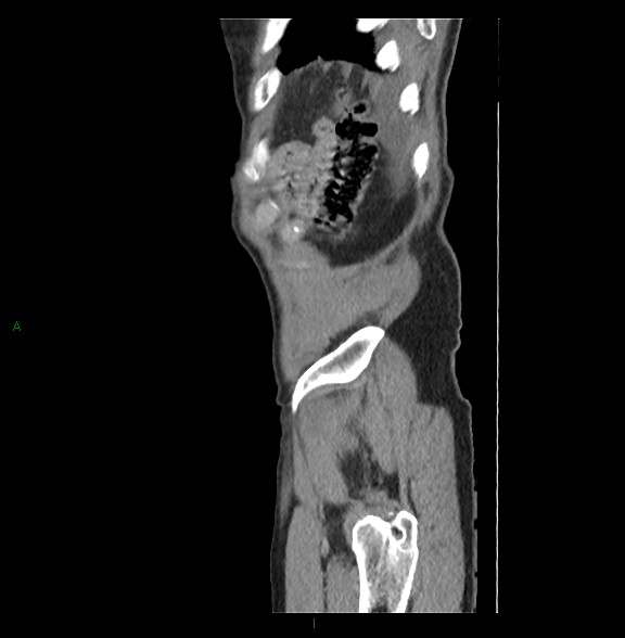 Closed loop small bowel obstruction with ischemia (Radiopaedia 84180-99456 C 85).jpg