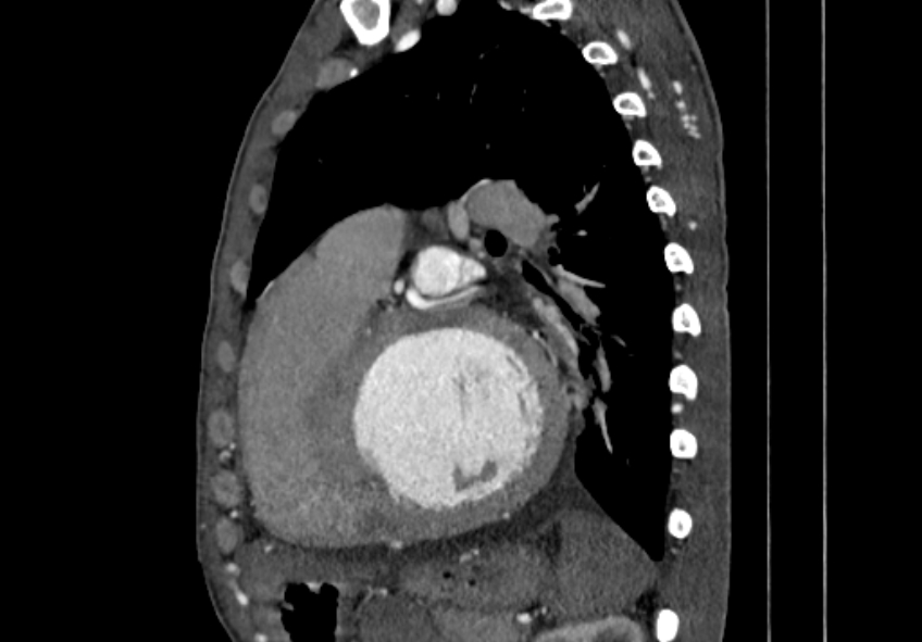 Coarctation of aorta with aortic valve stenosis (Radiopaedia 70463-80574 B 118).jpg