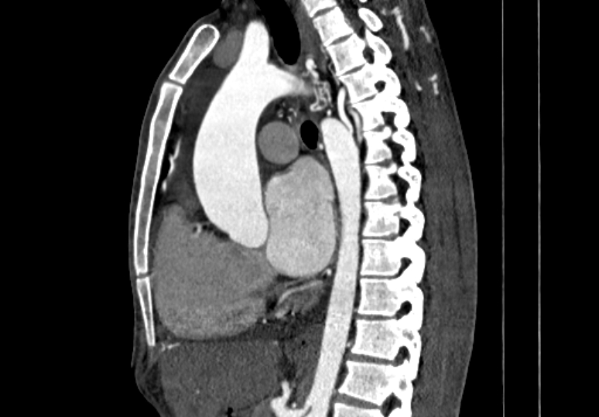 Coarctation of aorta with aortic valve stenosis (Radiopaedia 70463-80574 B 65).jpg