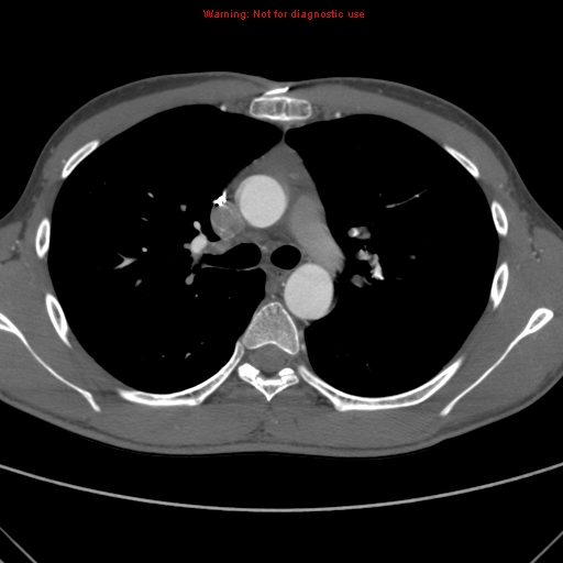 File:Coarctation of the aorta (Radiopaedia 9434-10118 A 72).jpg