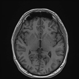 File:Cochlear incomplete partition type III associated with hypothalamic hamartoma (Radiopaedia 88756-105498 Axial T1 103).jpg