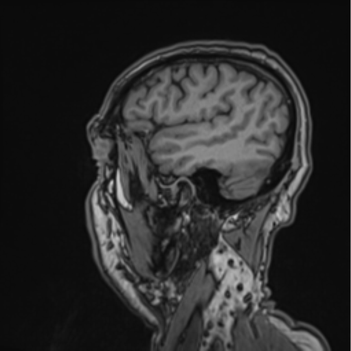 Colloid cyst of the third ventricle (Radiopaedia 86571-102662 Sagittal T1 63).png