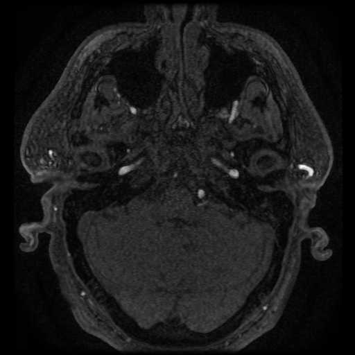 File:Colloid cyst with anterior communicating artery aneurysm (Radiopaedia 33901-35091 Axial MRA 73).jpg