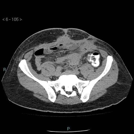 File:Colo-cutaneous fistula (Radiopaedia 40531-43129 A 44).jpg