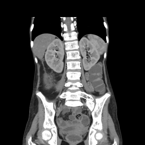 File:Colocolic fistula - Crohn disease (Radiopaedia 57063-63955 B 31).jpg
