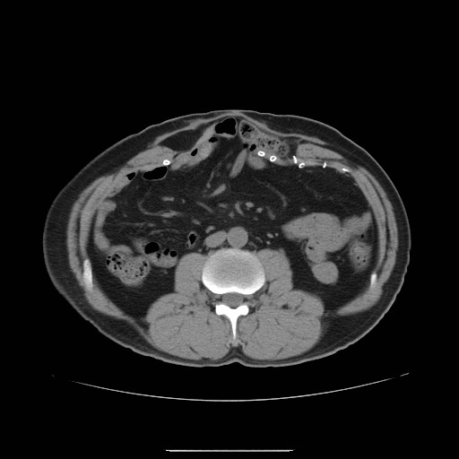 File:Colocutaneous fistula in Crohn's disease (Radiopaedia 29586-30093 Axial non-contrast 5).jpg