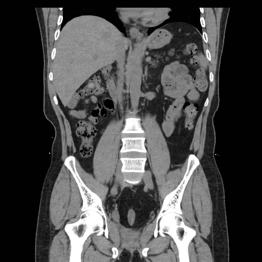File:Colocutaneous fistula in Crohn's disease (Radiopaedia 29586-30093 Coronal non-contrast 20).jpg