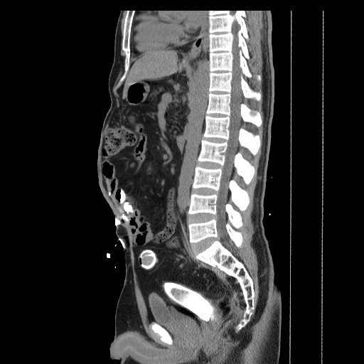 Colocutaneous fistula in Crohn's disease (Radiopaedia 29586-30093 F 17).jpg
