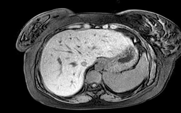 Colon adenocarcinoma with Krukenberg tumors, advanced pregnancy (Radiopaedia 67279-76645 A 71).jpg