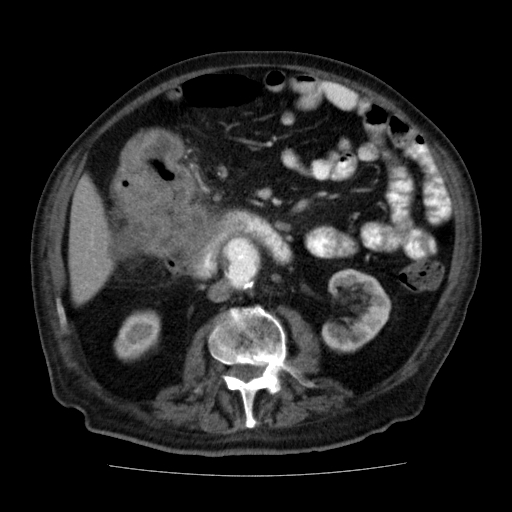 File:Colon cancer with duodenal invasion (Radiopaedia 16278-15958 A 29).jpg