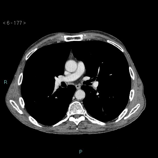 File:Colonic cancer (ultrasound and TC imaging) (Radiopaedia 50346-55713 B 177).jpg