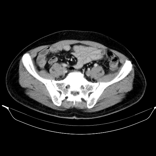 Colonic lipoma with colo-colic intussusception (Radiopaedia 58944-66200 A 50).jpg