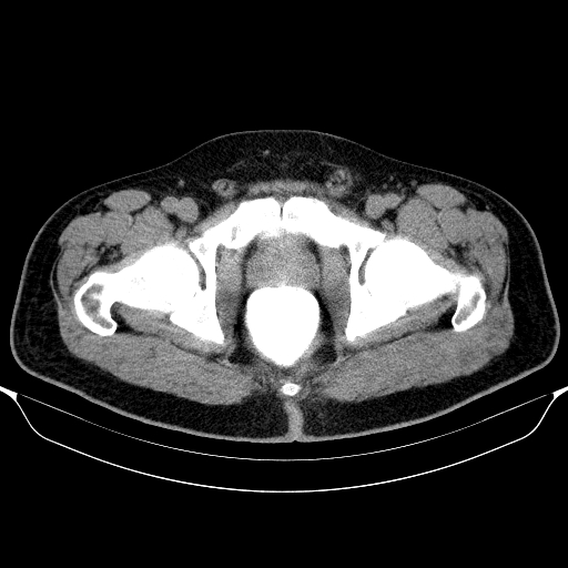 Colonic lipoma with colo-colic intussusception (Radiopaedia 58944-66200 Axial C+ rectal 73).jpg