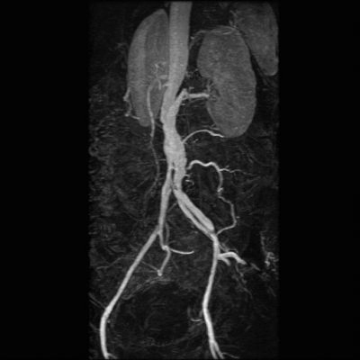 File:Iatrogenic abdominal aortic dissection (Radiopaedia 13757).jpg