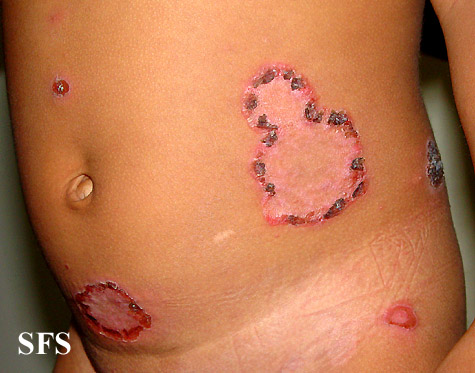 File:Impetigo (Dermatology Atlas 50).jpg