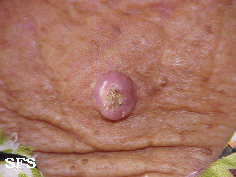 File:Keratoacanthoma (Dermatology Atlas 7).jpg