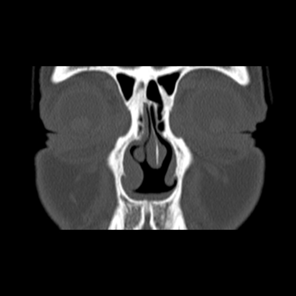 Nasal septal perforation (Radiopaedia 25030-25289 Coronal bone window 18).jpg