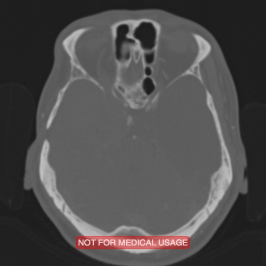 Nasopharyngeal carcinoma recurrence - skull base destruction (Radiopaedia 29107-29490 Axial bone window 71).jpg