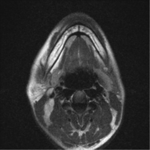 File:Nasopharyngeal carcinoma with pterygopalatine fossa involvement (Radiopaedia 33102-34134 Axial T2 3).png