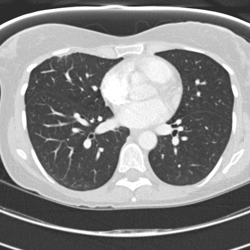 File:Necrobiotic pulmonary nodules - Crohn disease (Radiopaedia 20723-20631 Axial lung window 82).jpg