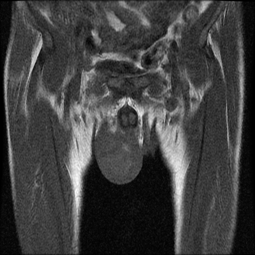 File:Necrotizing epididymo-orchitis with intra-testicular abscess (Radiopaedia 29397-29860 Coronal T1 8).jpg