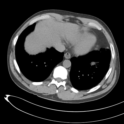 File:Necrotizing pancreatitis with acute necrotic collections (Radiopaedia 38829-41012 Axial non-contrast 9).png