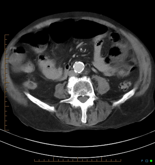 Necrotzing fasciitis due to a perforated adenocarcinoma of the splenic flexure (Radiopaedia 46930-51455 A 39).jpg