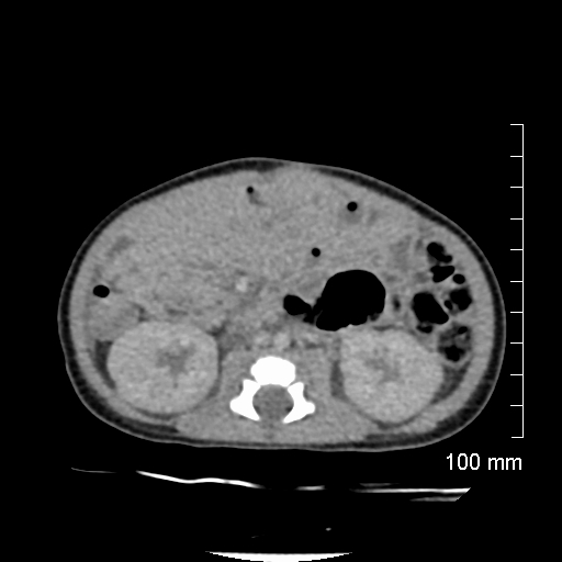 File:Neonatal neuroblastoma (Radiopaedia 56651-63438 Axial non-contrast 46).jpg