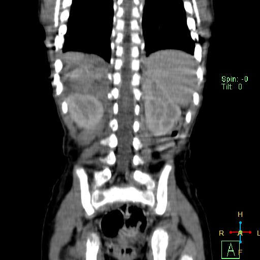 File:Neuroblastoma (Radiopaedia 24751-25016 B 20).jpg